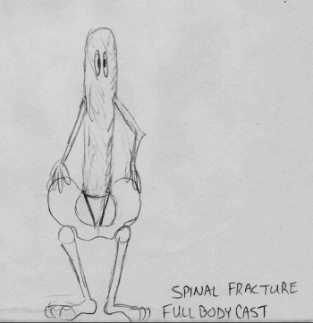 spinal-fracture-sketch